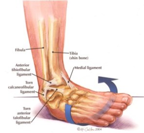 ankle rolled outward