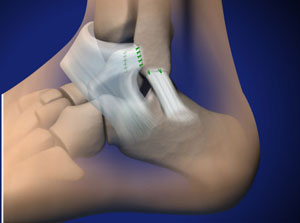 lateral ankle ligament reconstruction